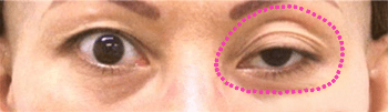 眼瞼下垂（まぶたの開きが悪い）の状態【画像】