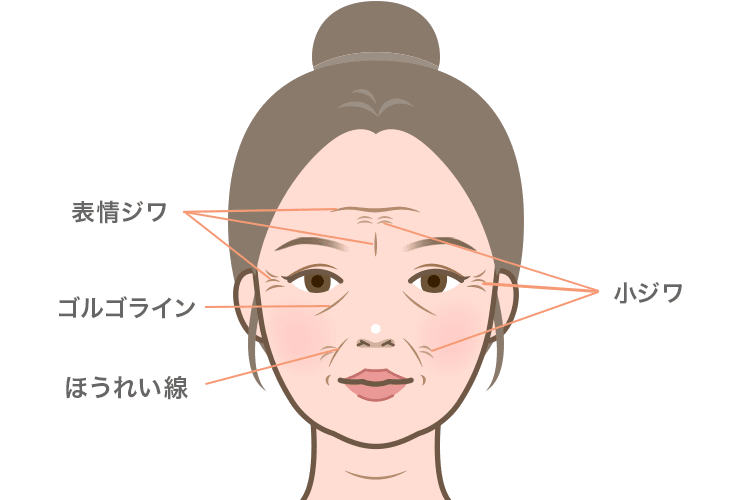 小ジワ、表情ジワ、ゴルゴライン、ほうれい線