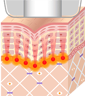 HIFUエネルギーを照射
