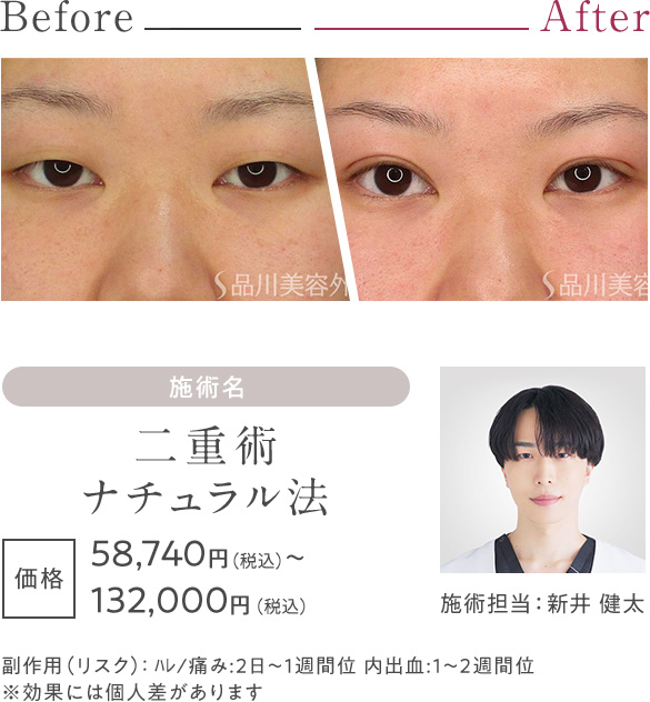 二重術ナチュラル法