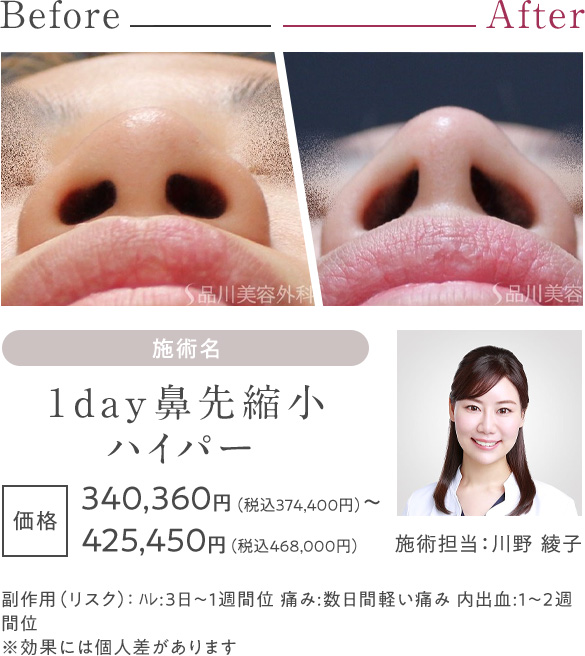 1day鼻先縮小ハイパー