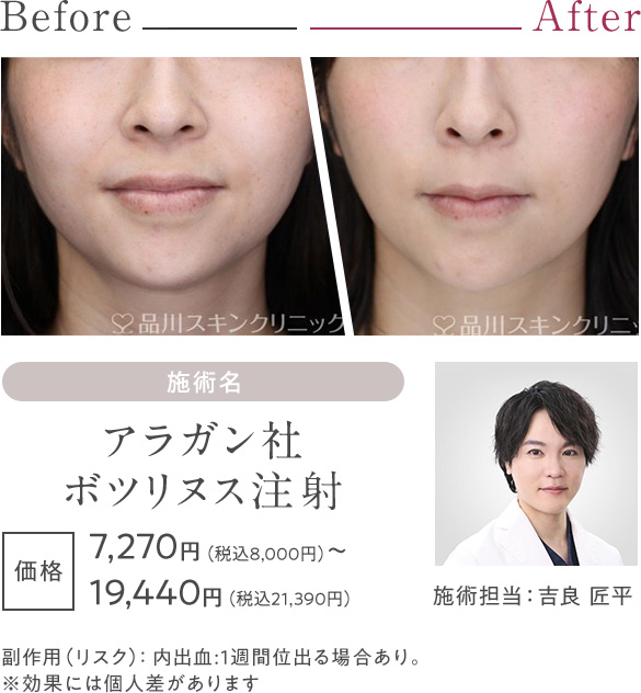 アラガン社ボツリヌス注射