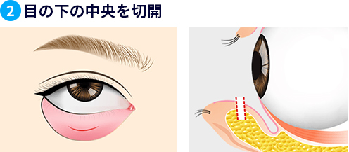 目の下の中央を切開