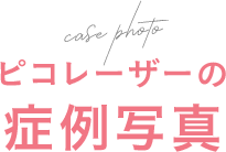 ピコレーザーの症例写真