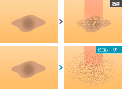 レーザー治療の比較イメージ