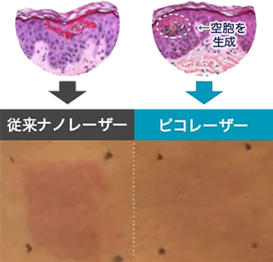 従来のナノレーザーとピコレーザーの比較イメージ