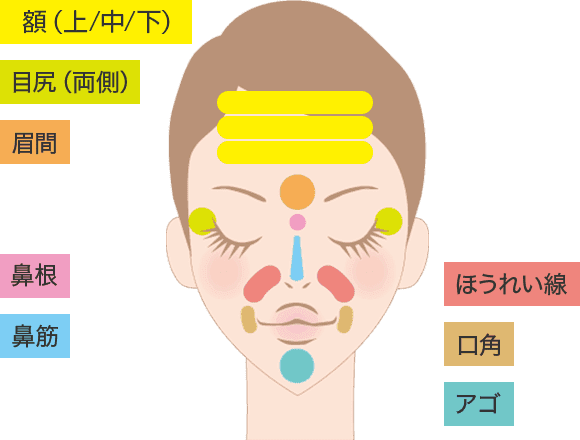 ヒアルロン酸によるプチ整形。額（上/中/下）・目尻（両側）・眉間・鼻根・鼻筋・ほうれい線・口角・アゴ