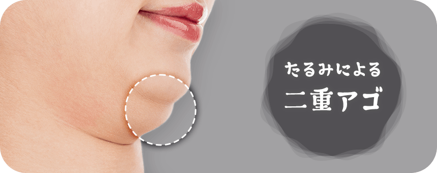 たるみによる二重アゴ