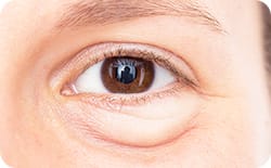 目元の筋力（眼輪筋）の衰え